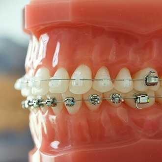 Model smile with clear braces on top teeth and metal braces on bottom teeth