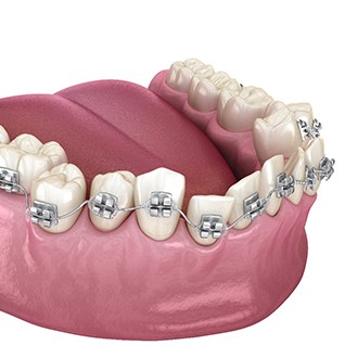 3D illustration of traditional braces ?