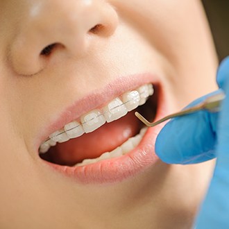 Closeup of teeth with clear and ceramic braces