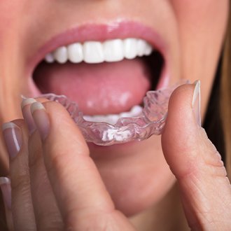 Closeup of patient placing Invisalign tray