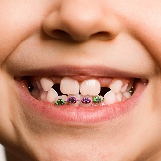 Closeup of smile with pediatric orthodontics