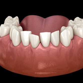 A digital image of overcrowded teeth sitting along the lower arch