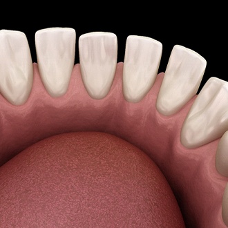 A digital image of the lower arch of teeth, each with a gap between them