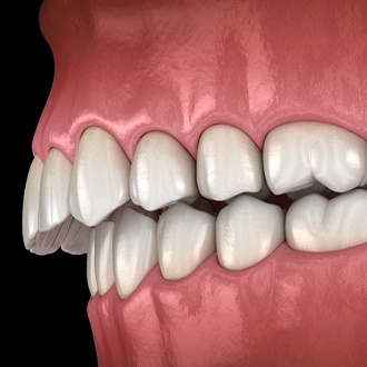 A digital image of an overbite with the top teeth protruding over the bottom teeth