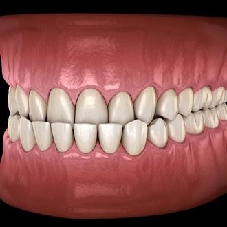 A digital image of an underbite with the top teeth sitting inside the lower teeth