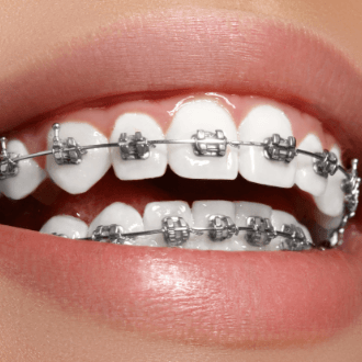 Closeup of teeth with clear and ceramic braces