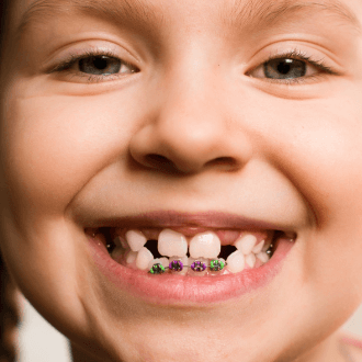 Closeup of child with pediatric orthodontics