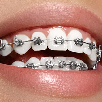 Closeup of teeth with traditional braces