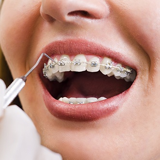 Closeup of orthodontist placing traditional braces