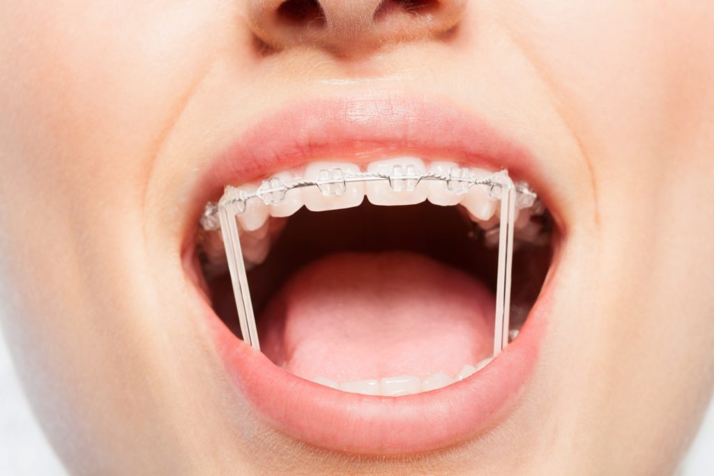 Closeup of patient with rubber bands on braces